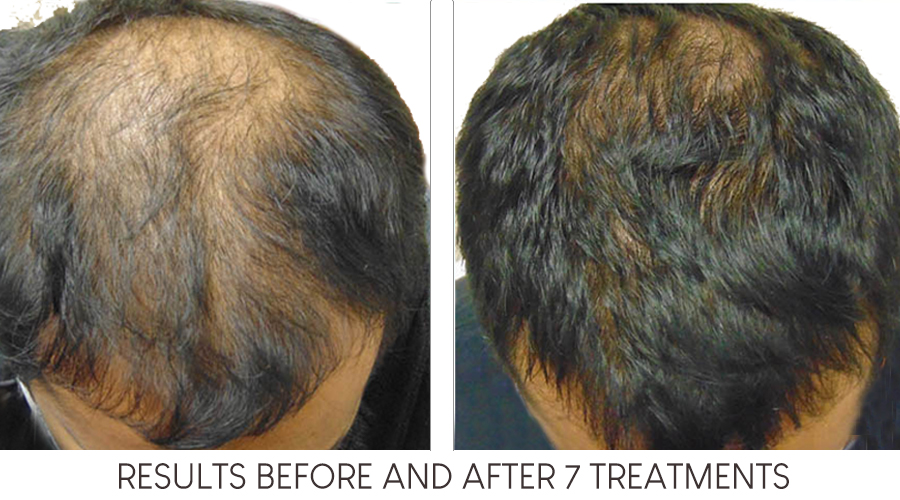 Hair Restoration 1