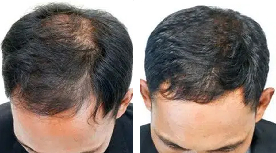 Hair Restoration 2